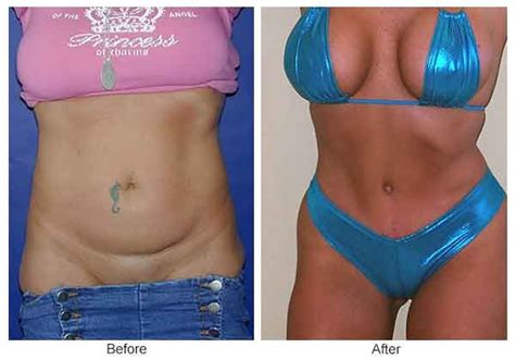 Pin On Liposuction Before And After