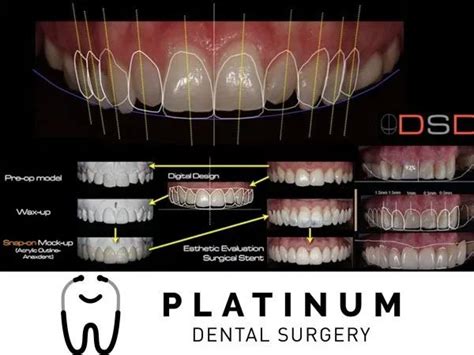 Smile Design And Veneers Platinum Dental Surgery