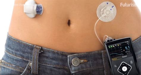 Artificial Pancreas New Hope For Diabetics Mybusinessfuture