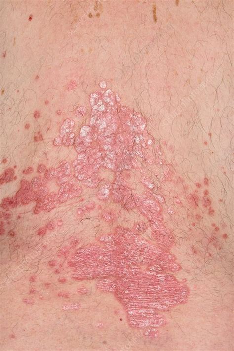 Plaque Psoriasis Stock Image C0426392 Science Photo Library