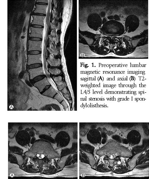 Figure 1 From Postlaminectomy Bilateral Lumbar Intraspinal Synovial