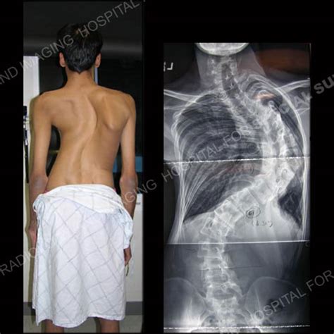 Scoliosis In Adults An Overview