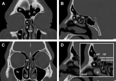 Overview Of Frontal Sinus Pathology And Management Otolaryngologic