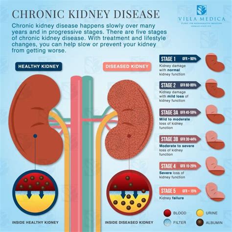 Villa Medica Chronic Kidney Disease Explained Infographic Chronic