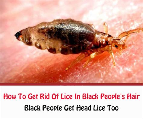 How To Get Rid Of Lice In African American Hair Astersfaruolo