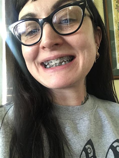 Just Got My Braces On Excited To See The Outcome In 18 To 24 Months Rbraces