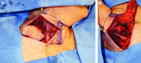 Intraoperative View Of Supraclavicular Lymph Node Flap Harvest A