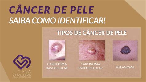 Tipos E Identificação Do Câncer De Pele