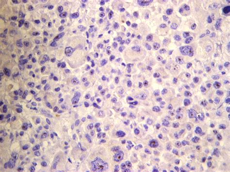 Alk Positive Diffuse Large B Cell Lymphoma Report Of Four Cases And
