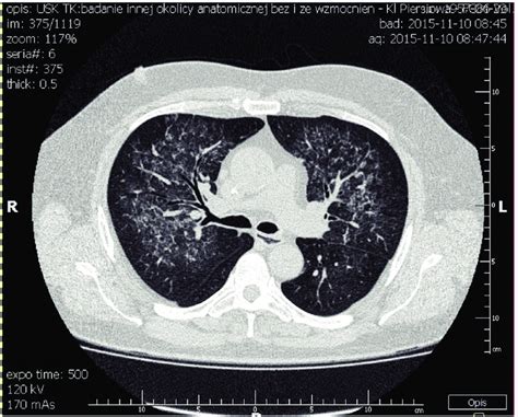 Chest Ct Showing Bilateral Coalescent Airspace Opacities And Extensive