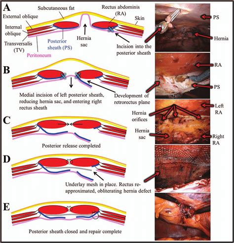 Robotic Retromuscular Abdominal Wall Reconstruction A Incision Into