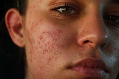 7 Types Of Bumps And Blemishes You Should Never Try To Pop Gaya Gaya