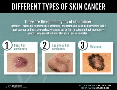 4 Types Of Skin Cancer