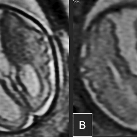 Axial A And B Fetal Mri Images Demonstrate A Third Ventricle