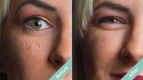 How To Cover Acne Scars With A Hollywood Secret Youtube
