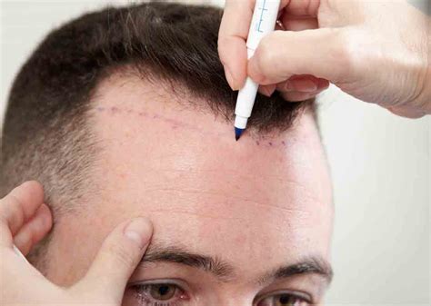 Which Is The Best Hair Transplant Clinic In Delhi And Why Spikysnail