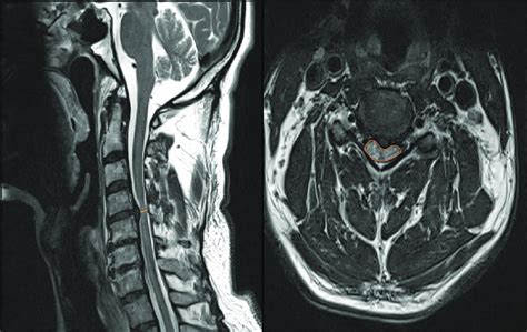 Cervical Sagittal And Axial T2w Mri Sequences In A Representative
