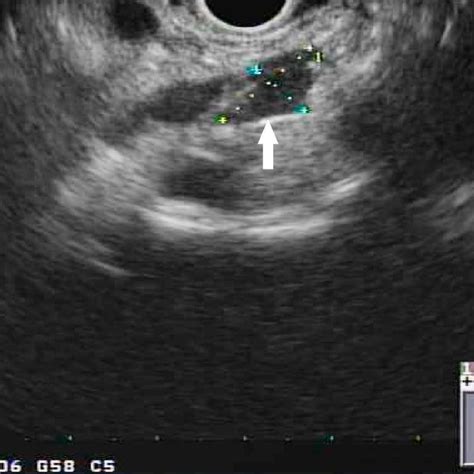 Endoscopic Ultrasound Showing Irregular Hypoechoic Mass In The