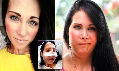 Jannine Mchaffie Has Half Her Face Removed To Try And Beat Adenoids