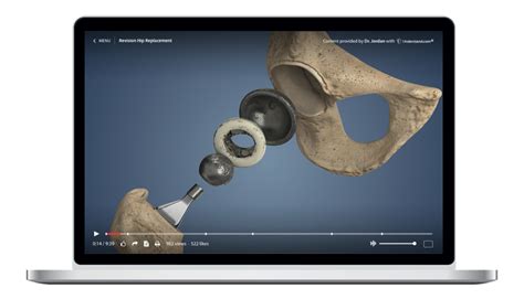 Revision Hip Replacement Animation