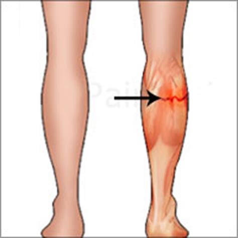 The calf muscle (gastrocnemius) becomes the achilles tendon about midway in the lower leg. Lower Leg Injuries | Pulled Calf Muscles