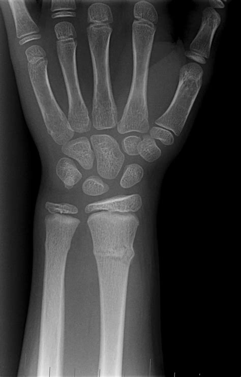 Fracture Wrist Fracture Treatment