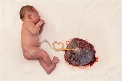 The risk of placenta accreta spectrum in women with in vitro whole blood transfusion reduces overall component transfusion in cases of placenta accreta. 10 things to do with your placenta after giving birth ...