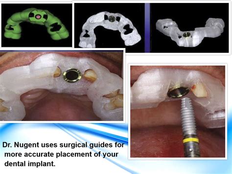 Guided Dental Implant Surgery In Pasadena Tx