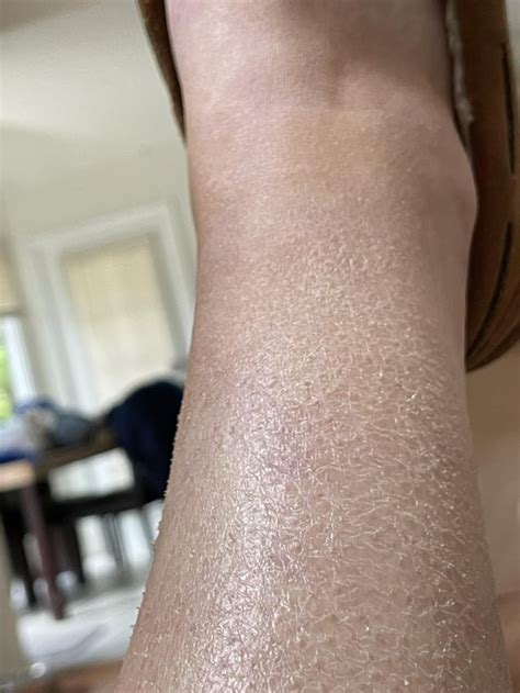 Skin Concern Chronic Scaley Flakey Dry Skin On Legs R