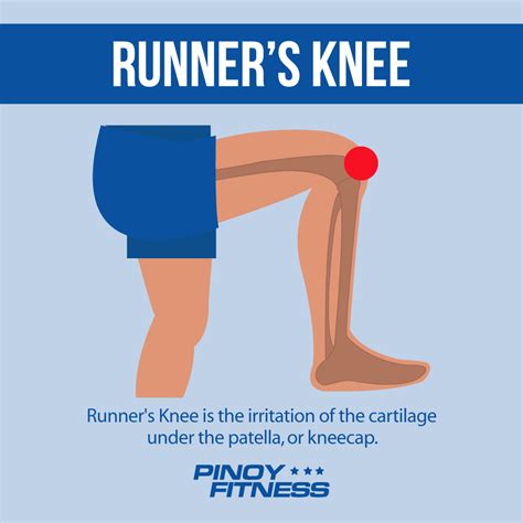 How To Treat Knee Nerve Pain