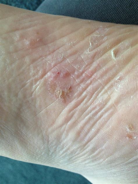 Is This Eczema On The Bottom Of My Foot Reczema