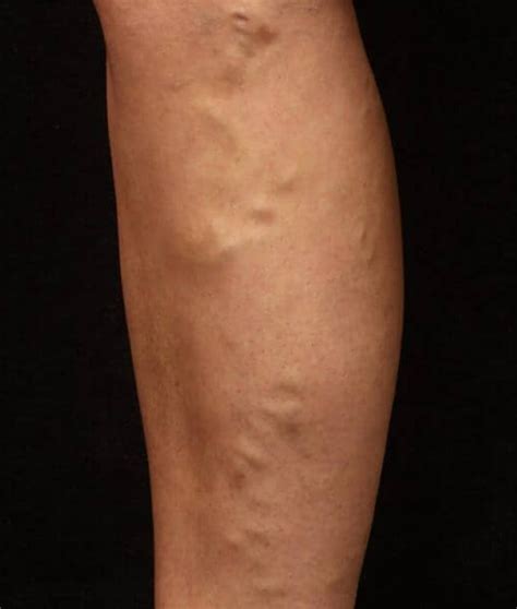 Patient 37499558 Endovenous Laser Therapy Before And After Photos