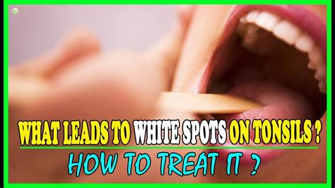 What Leads To White Spots On The Tonsils And How To Treat It Best