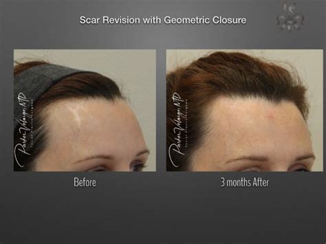 Scar Revision Archives New Orleans Premier Center For Aesthetics And