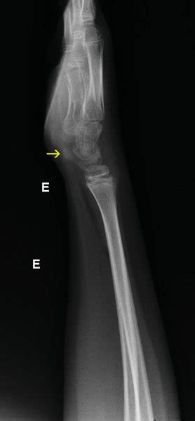 Lateral Radiography View Of The Left Wrist Showing The