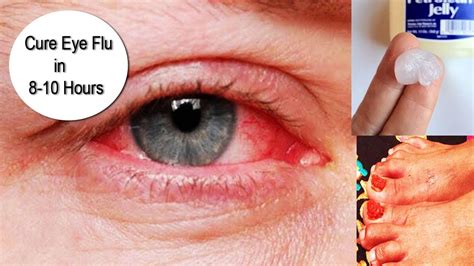 Curing Eye Flu Tested And Verified Homemade Remedy To Cure Eye Flu
