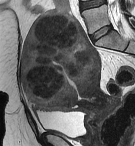 Uterine Leiomyomas Radiology Case