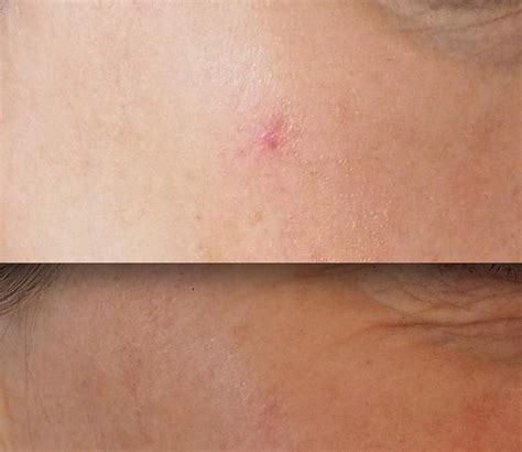 Removing A Red Spot On The Face Best Clinic Sydney For Dermal Fillers