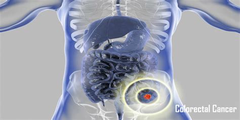 All You Need To Know Colorectal Cancer Before Taking A Treatment