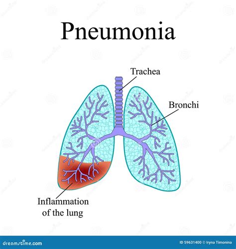 Pneumonia The Anatomical Structure Of The Human Stock Vector