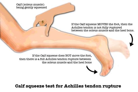 Calf Injuries Pulls Strains Tears Ruptures And Myositis Riktr Pro