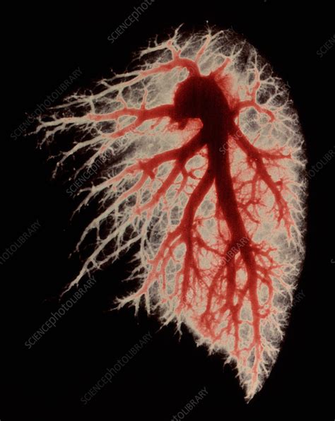 Coloured Angiogram Of Pulmonary Arteries Of Lung Stock Image P590