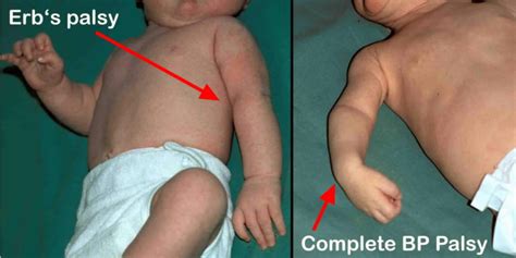 Brachial Plexus Injury At Birth Causes Symptoms And Treatment