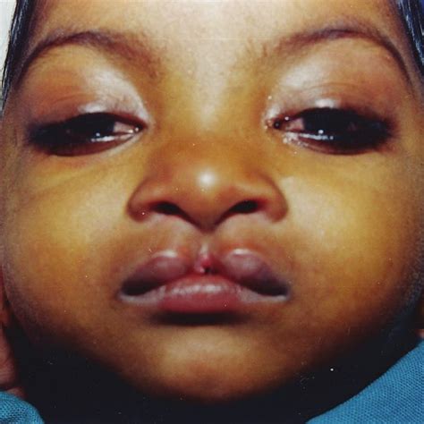 Preoperative Appearance Illustrating The Median Cleft Of The Upper Lip