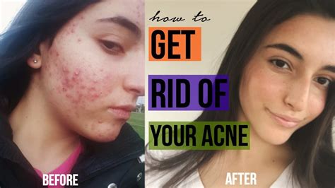 How I Got Rid Of My Acne Forever Skincare Routine Youtube