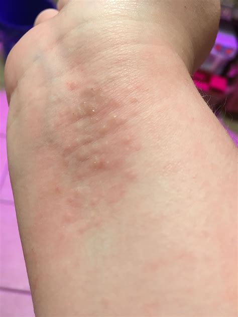 Ive Had This Itchy Patch On The Inside Of My Wrist For 3 Days Now The