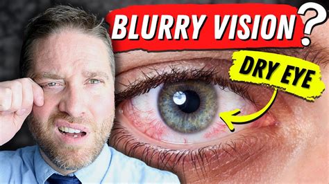 Why Dry Eyes Cause Blurry Vision - 3 Reasons, And 3 Home Remedies - YouTube