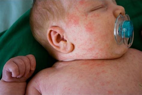 Milk Allergies In Babies Best Allergist Nyc Boyan Hadjiev Md