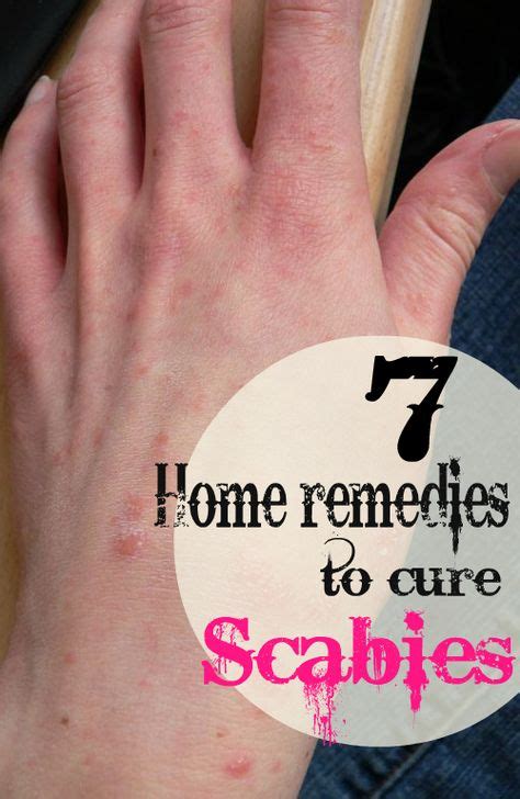 14 Scabies Ideas Scabies Home Remedies For Scabies Scabies Treatment