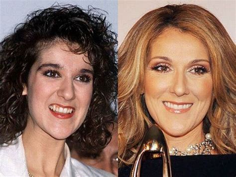 Celine Dion Celebrity Teeth Celebrity Smiles Hair Implants
